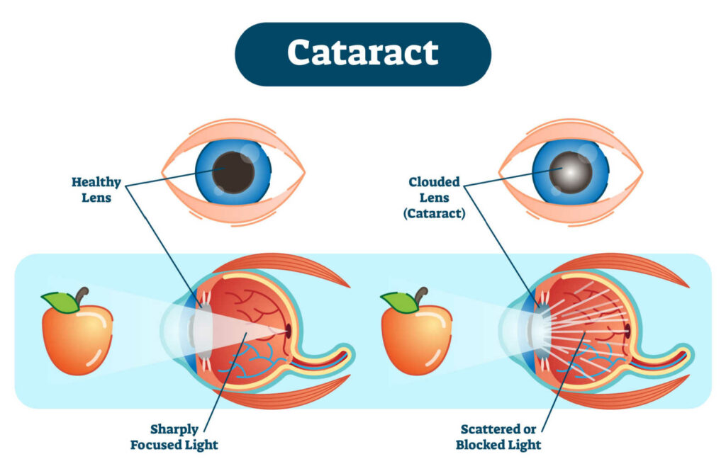 An infographic showing the difference between a healthy eye lens and a lens with cataract deposition.
