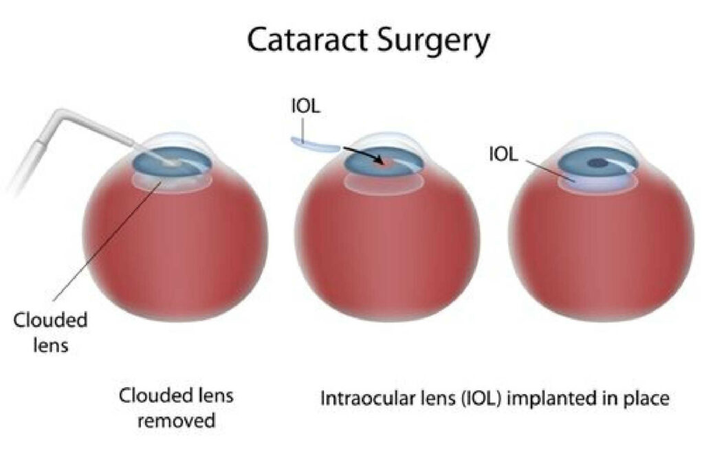 A graphical demonstration of how cataract surgery is done involving the removal of the cataract lens and implantation of the Intraocular lens (IOL).